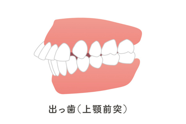 小児矯正