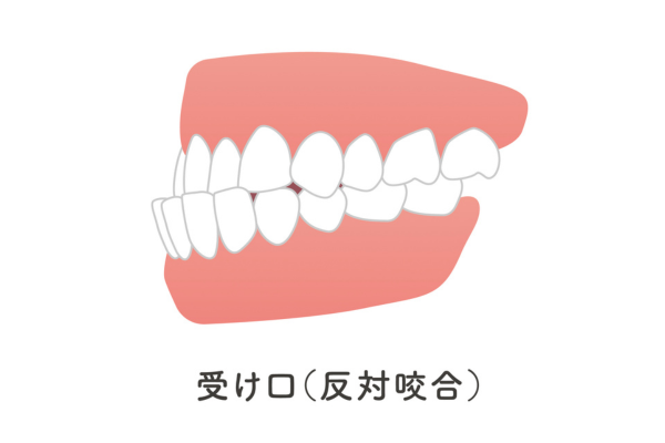 小児矯正