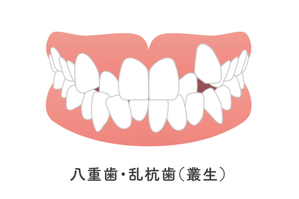 小児矯正