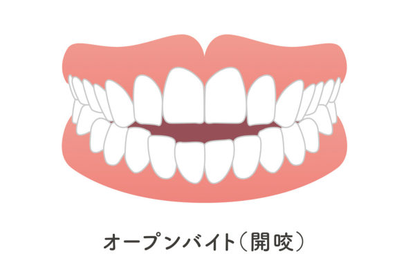 小児矯正