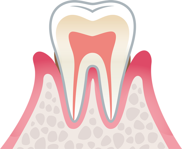 歯周病治療