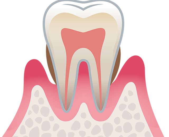 歯周病治療