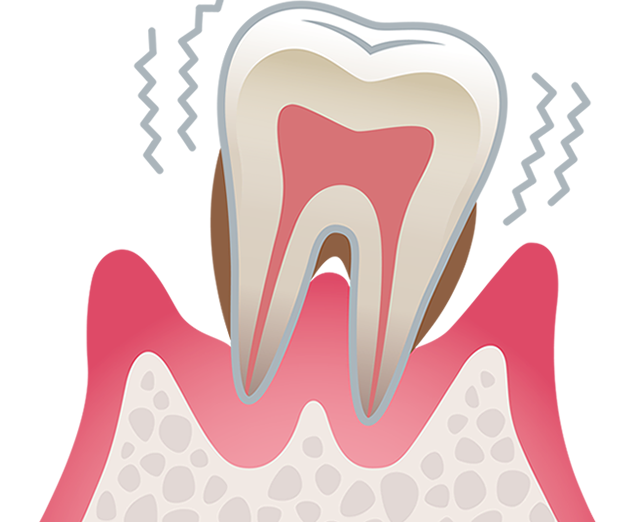歯周病治療