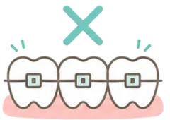 ブラケット装置をつけた歯のイラスト